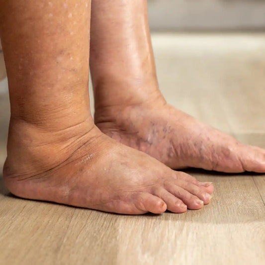 BONUS: TOP 10 REMEDIOS CASEROS PARA TRATAR EL EDEMA Y LA HINCHAZÓN